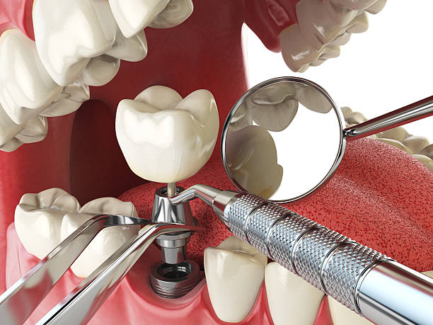 Best Emergency Tooth Extraction in Accokeek, MD